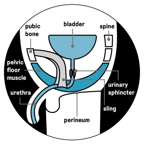 Internal male sling