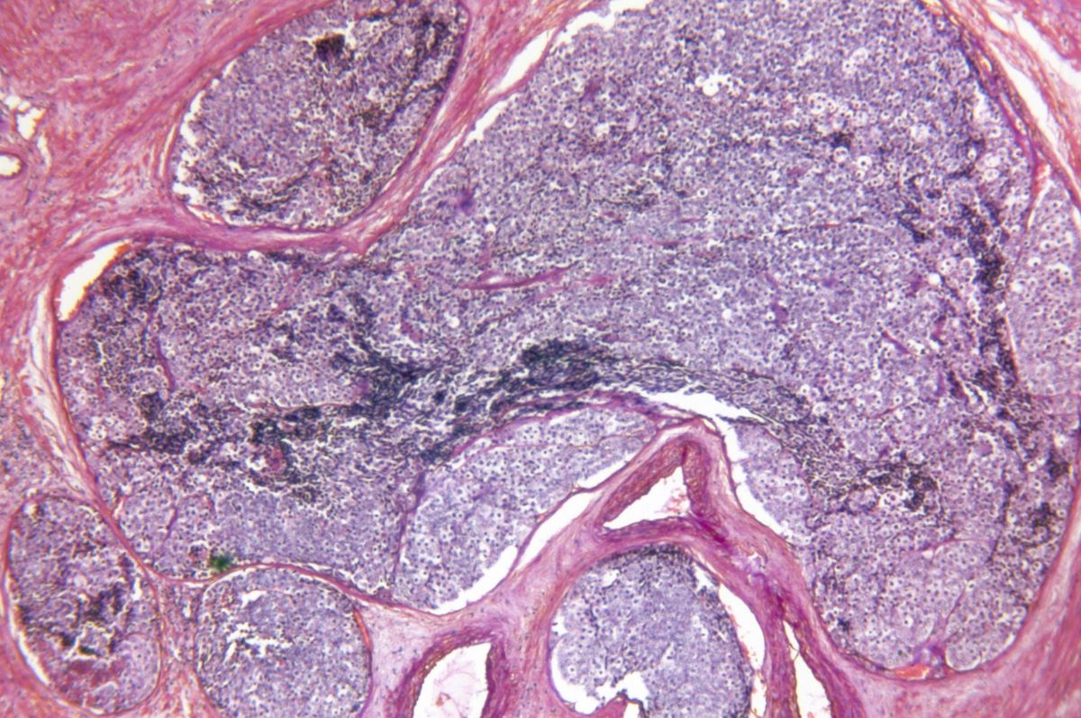 Cancer Slice 2