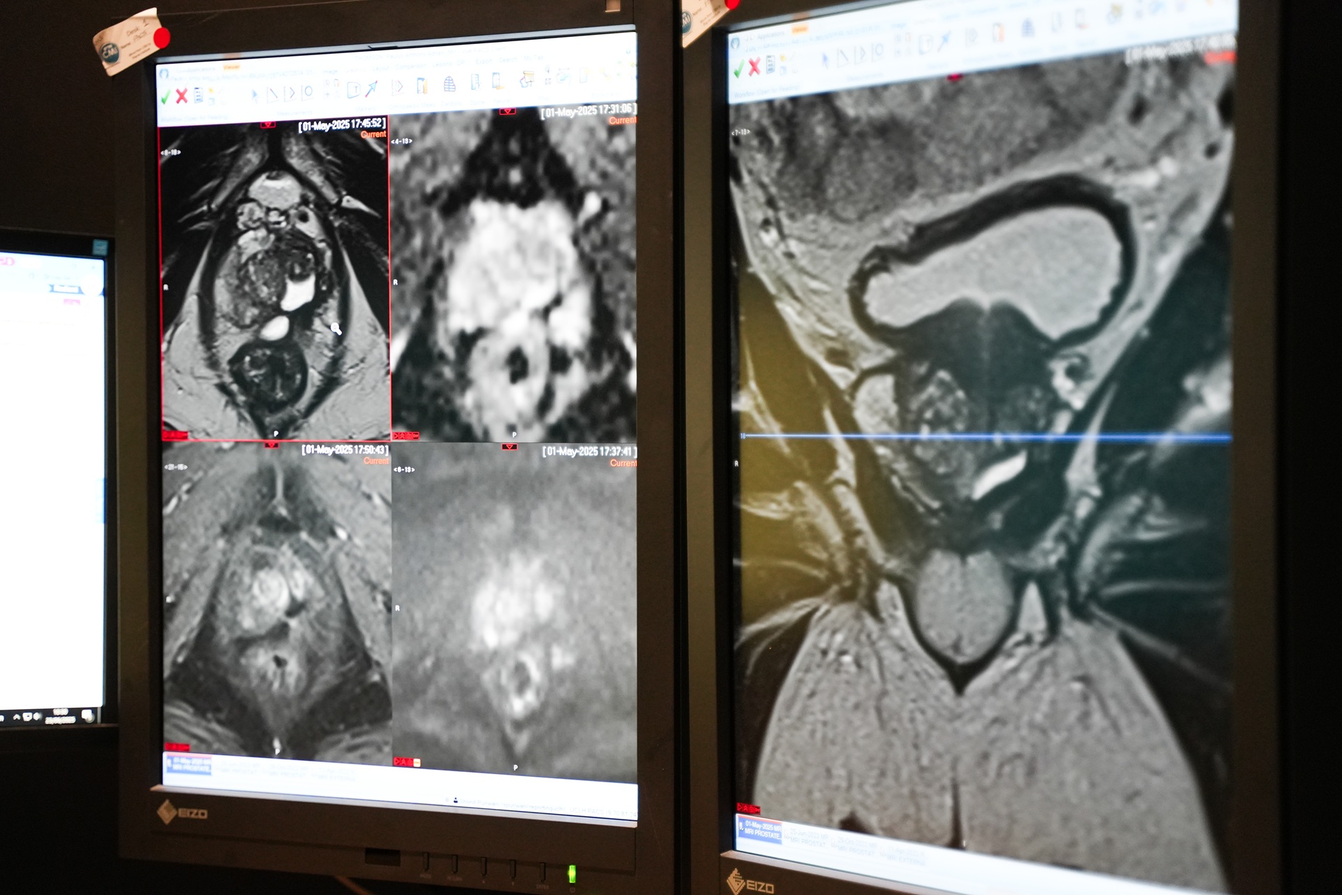 An MRI scan of a prostate.