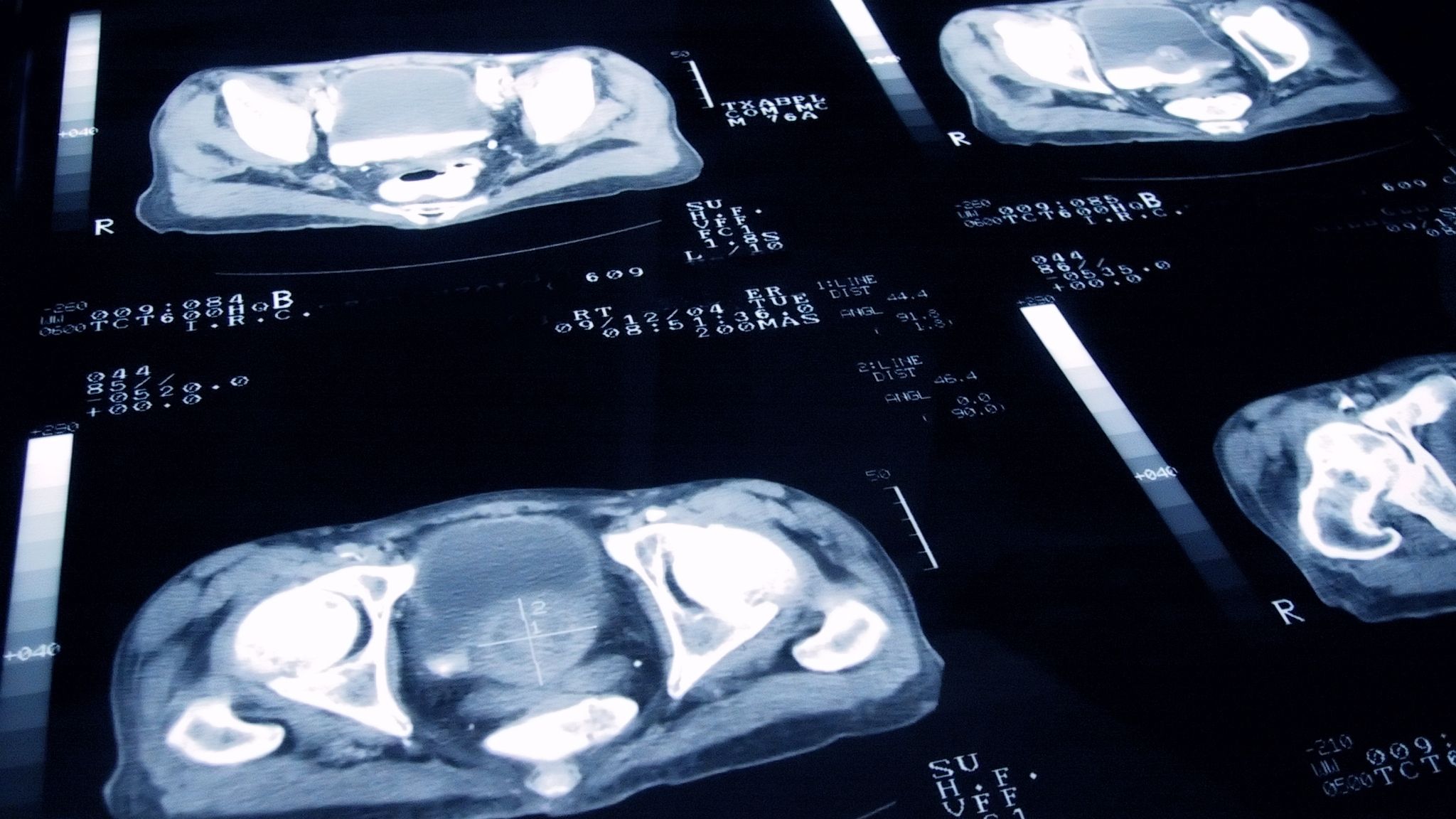 Skynews Prostate Cancer Scan 5853581
