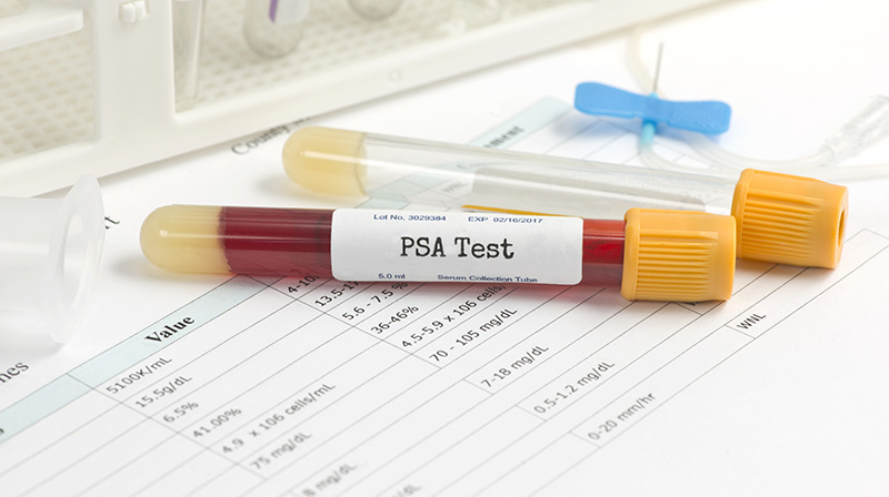 Image of PSA blood test