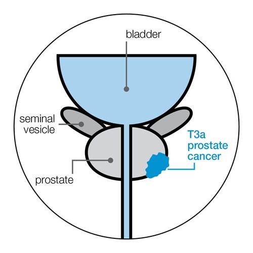 t3a-stage-prostate-cancer