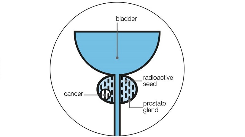 Brachytherapy Where The Seeds Go